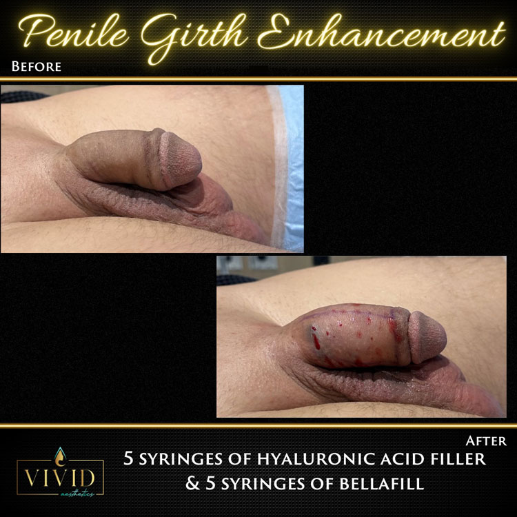 before and after of girth enhancement treatment at Vivid Aesthetics in Columbia SC.